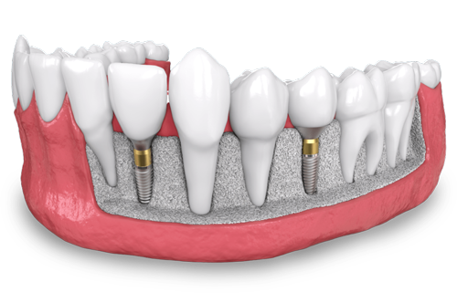 a model showing two placed dental implants