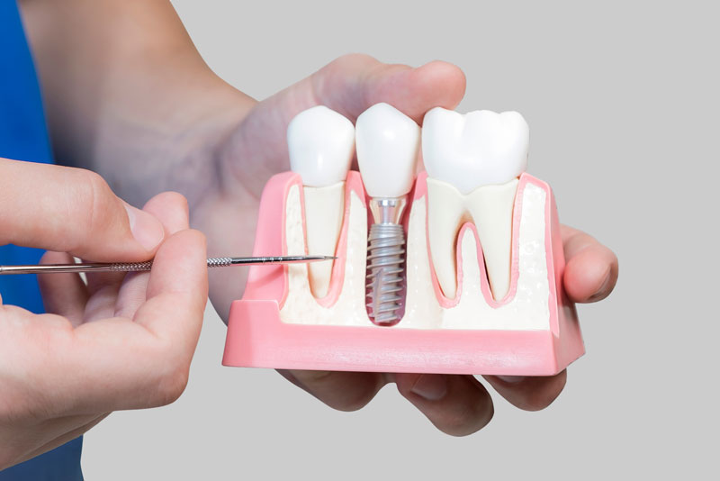 Dental Assistant Showing Off A Dental Implant In A Jawbone Cutaway Model in St. Charles, IL