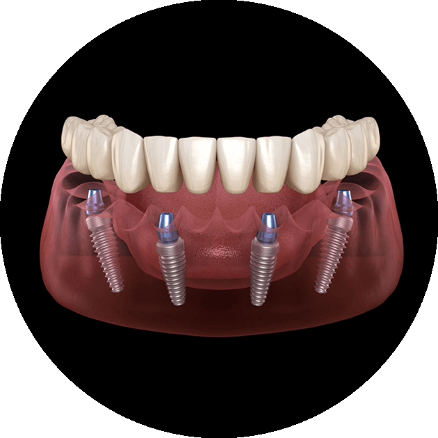 full arch dental implants