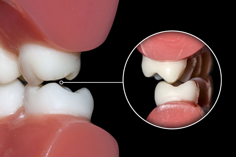 An image of a dental patient grinding their teeth.