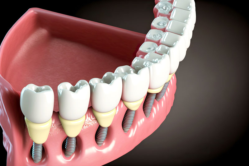 Close-up 3d model of a dental implant.