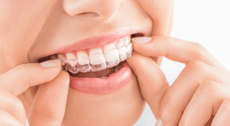 Close up photo of a woman putting a clear aligner on her teeth