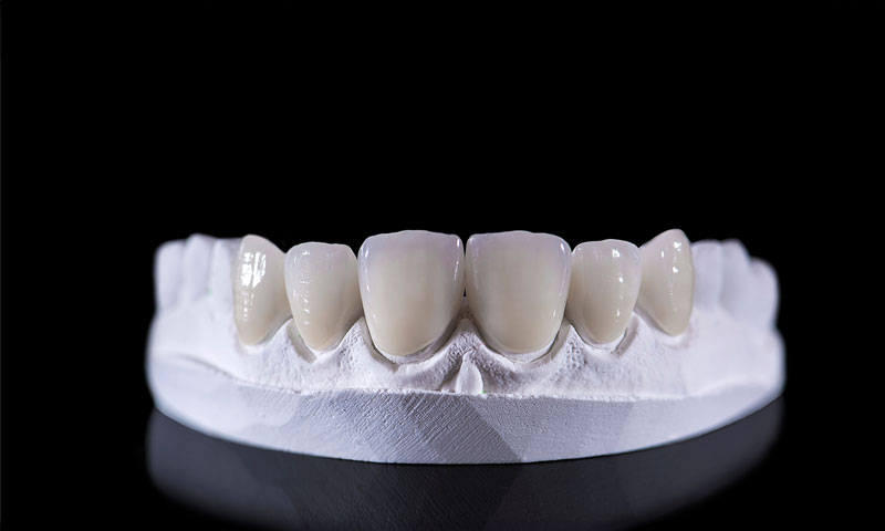 Dental veneers on a upper jaw model; laying on a black reflective table.