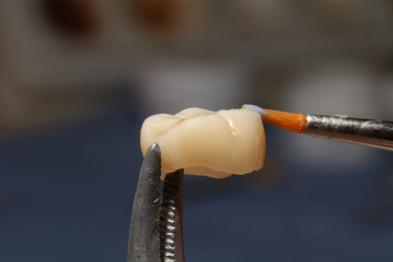 The image shows a close-up of a dental procedure where a prosthetic dental crown is being prepared. The crown is held by a dental tool, and a brush applies a bonding agent or adhesive to the surface. The background is blurred, emphasizing the crown and the brush.