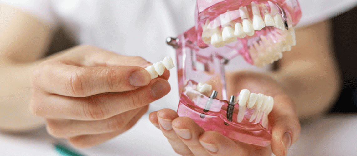 dentist implantologist showing dental bridge implant technology on human tooth jaw model.