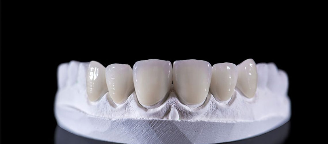 Dental veneers on a upper jaw model; laying on a black reflective table.