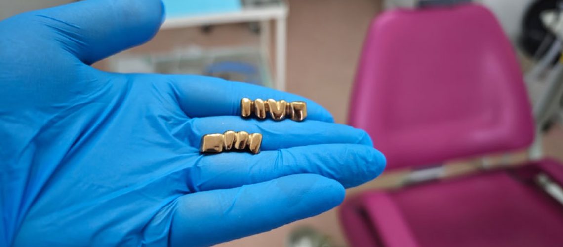 A yellow gold crown is delivered on a stone model and die, ready to be cemented in the mouth.