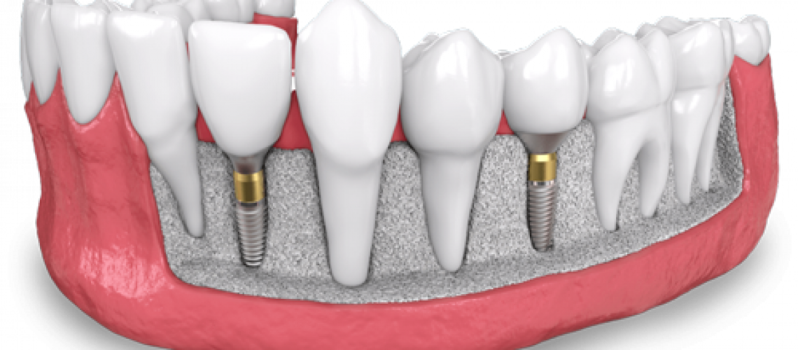 a model showing two placed dental implants