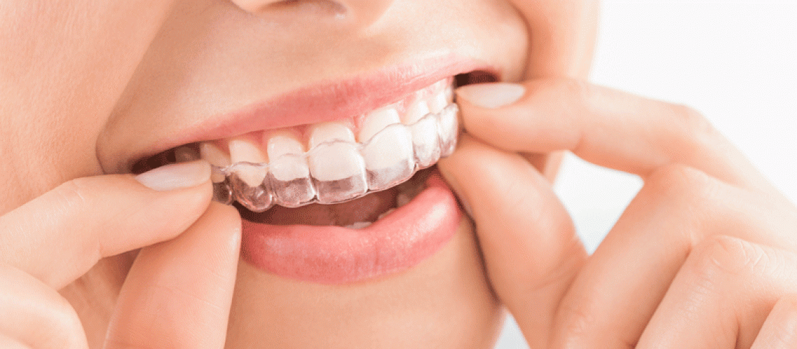 Close up photo of a woman putting a clear aligner on her teeth