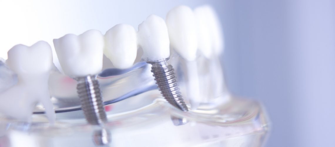 Dentist explaining bone graft procedure in professional setting