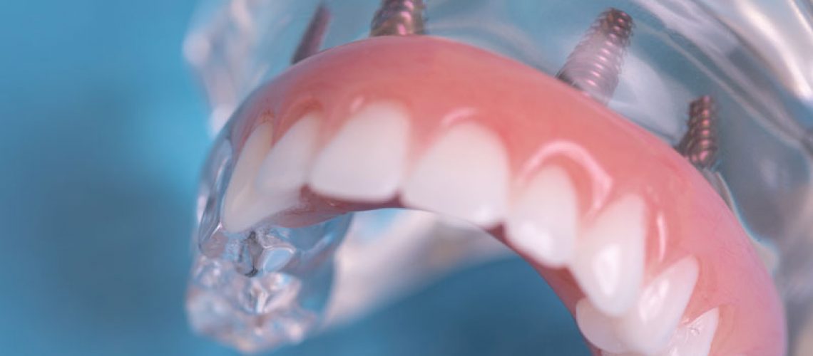 Full Arch Dental Implants Model