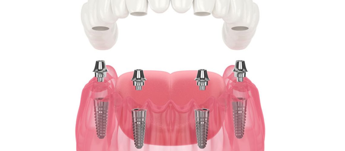 a digital model of a full mouth dental implant prosthetic.