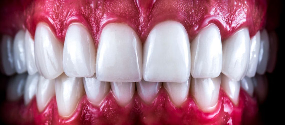 a set of full mouth dental implants after placement