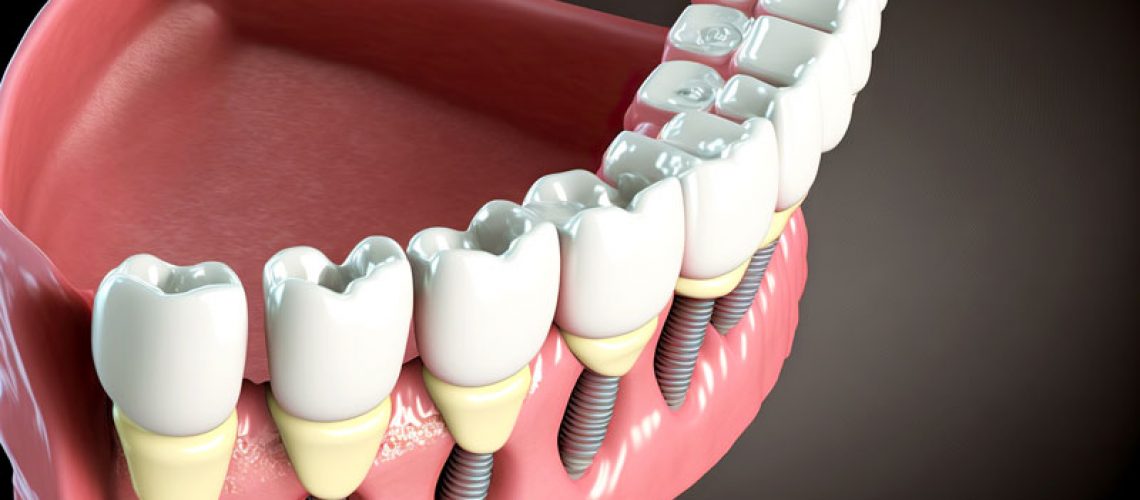Close-up 3d model of a dental implant.