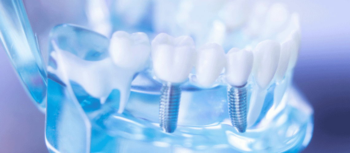 Dentist clear jaw model, dental tooth implant.