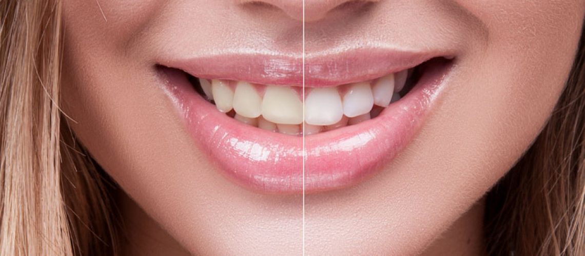 Tooth Whitening Patient Before And After
